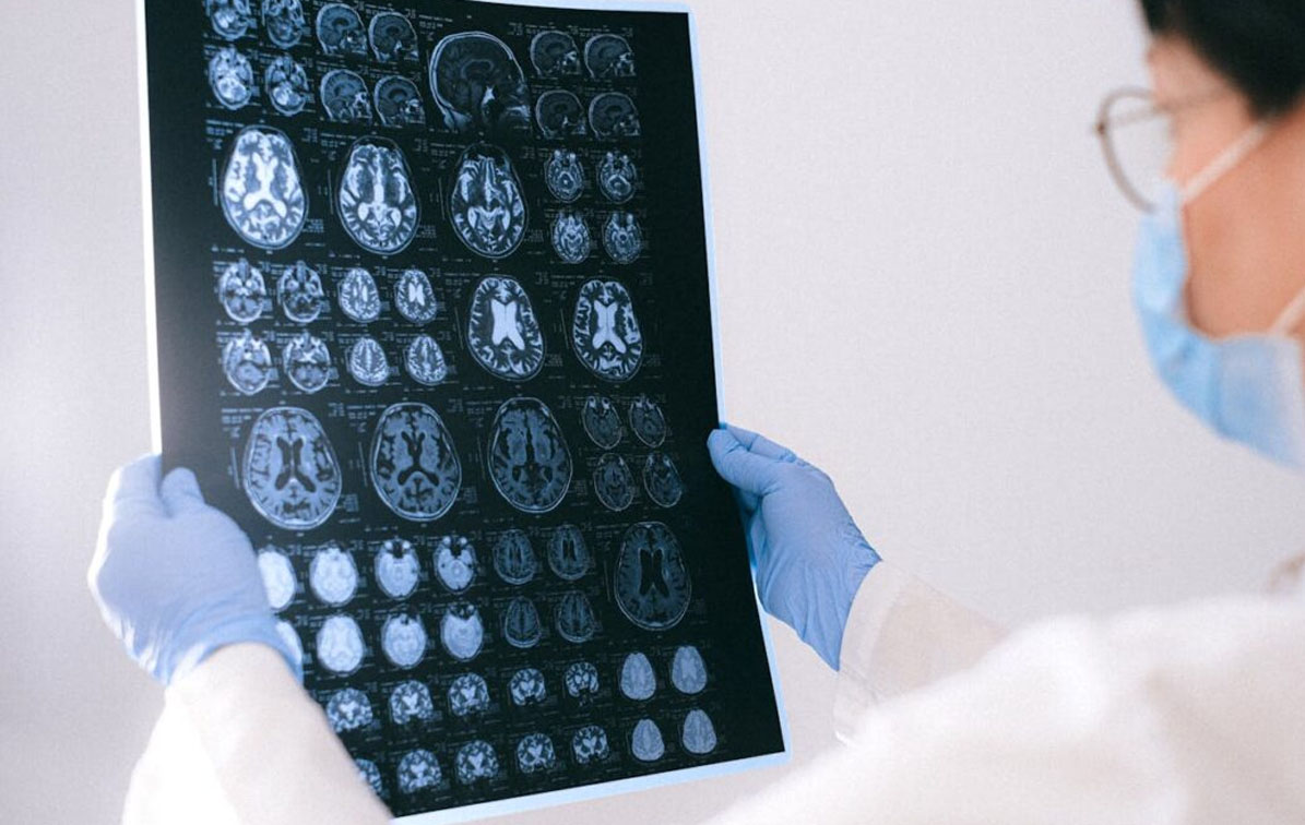 Cada vez tenemos más microplásticos en el cerebro